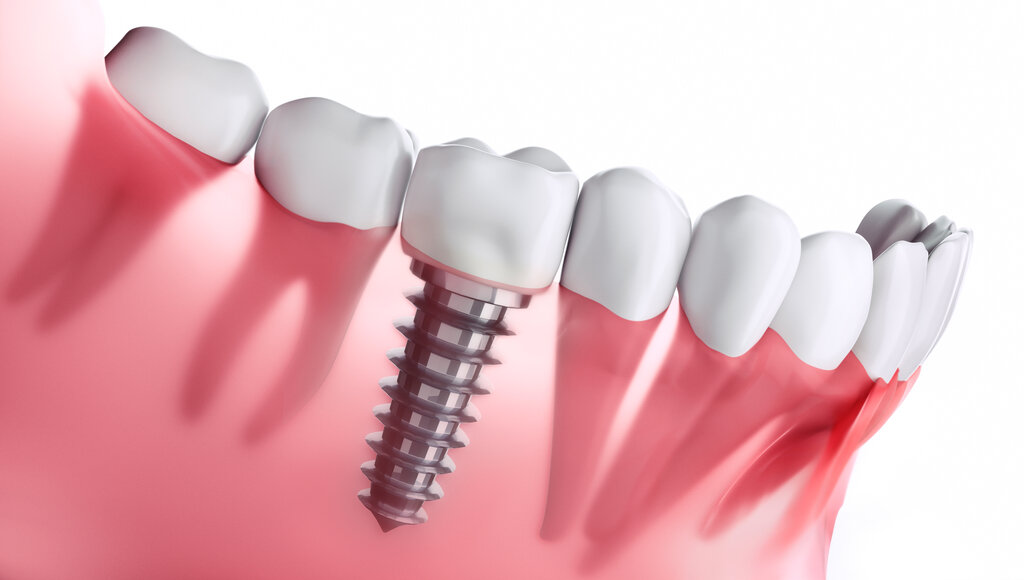 Risks and Benefits of Implant Restoration