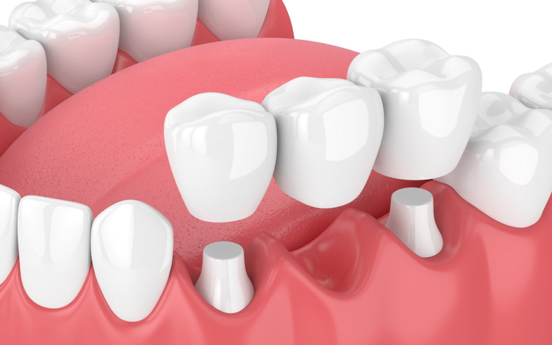 5 Pros of Dental Bridges