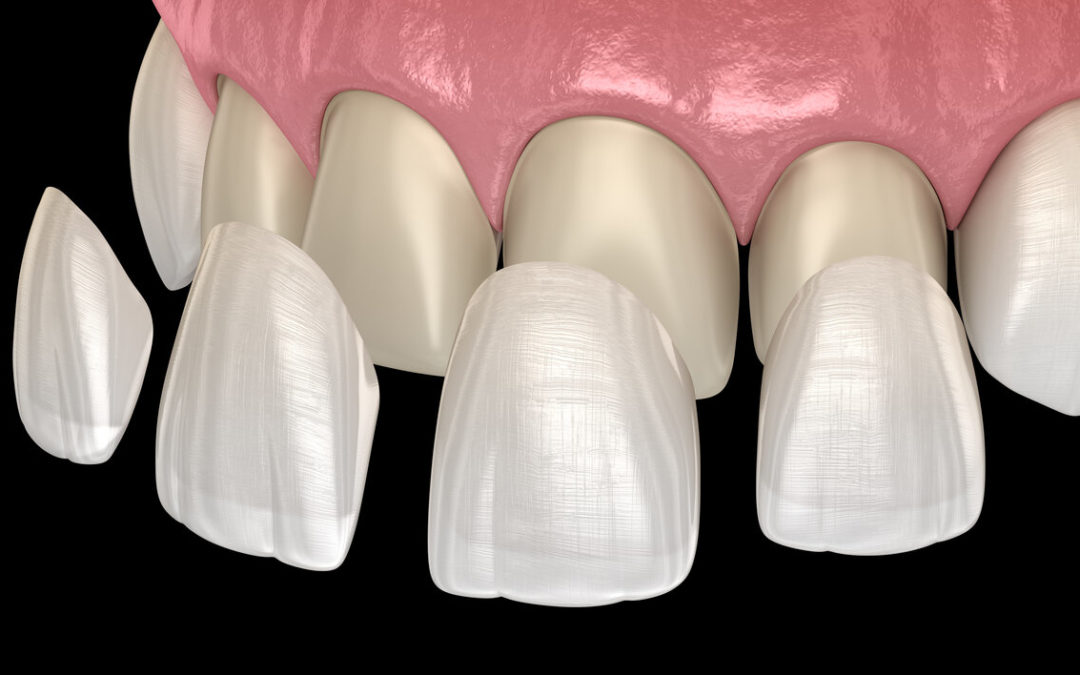 FAQs About Dental Veneers