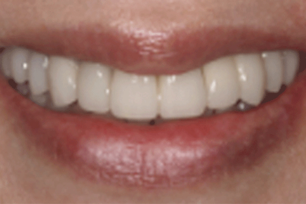 teeth whitening results 